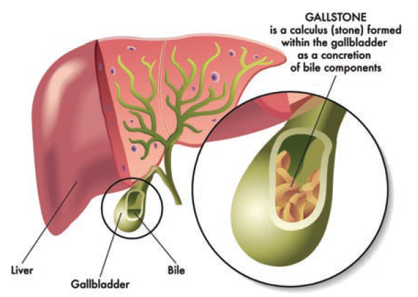gallstone2