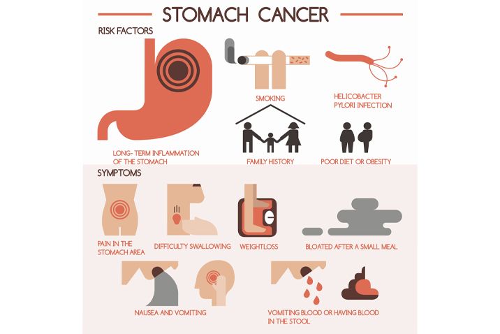 Stomach Cancer Causes Symptoms And Treatment - Infoupdate.org